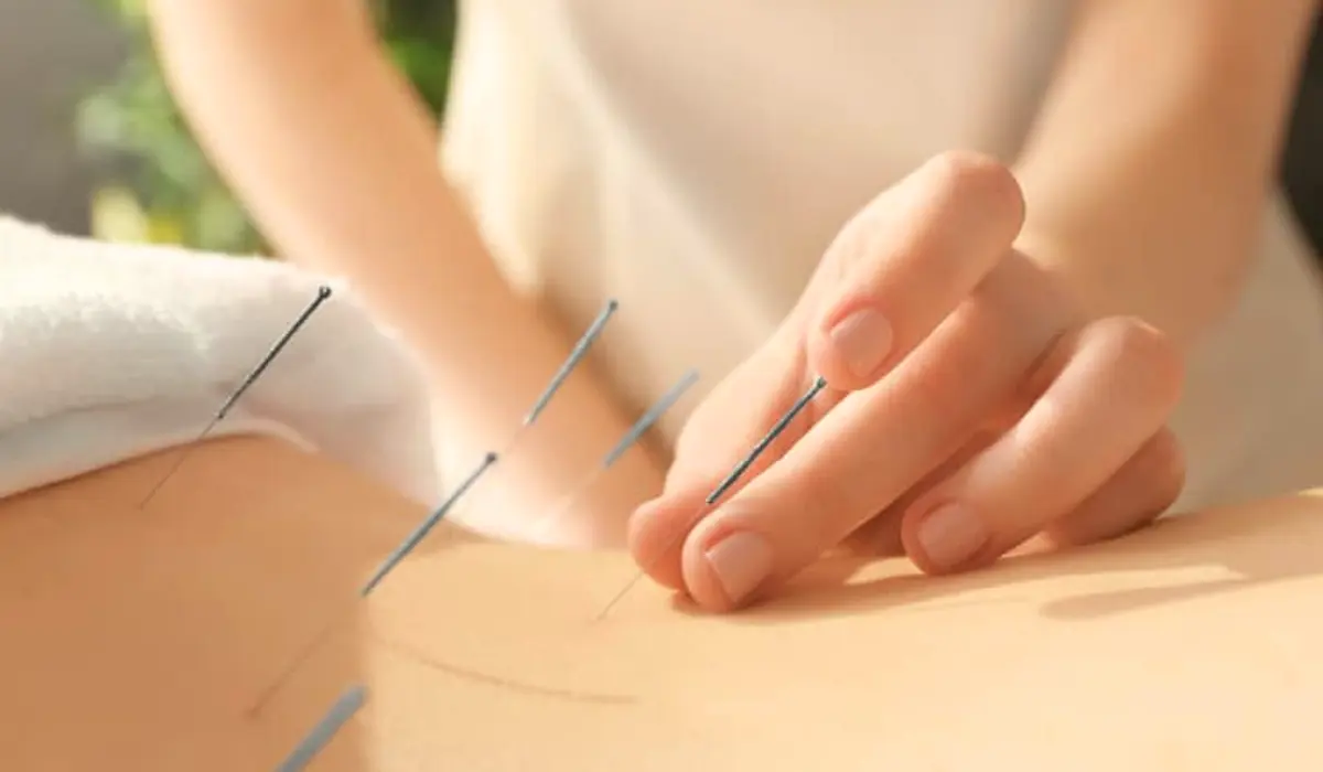 Acupuncture For CRPS