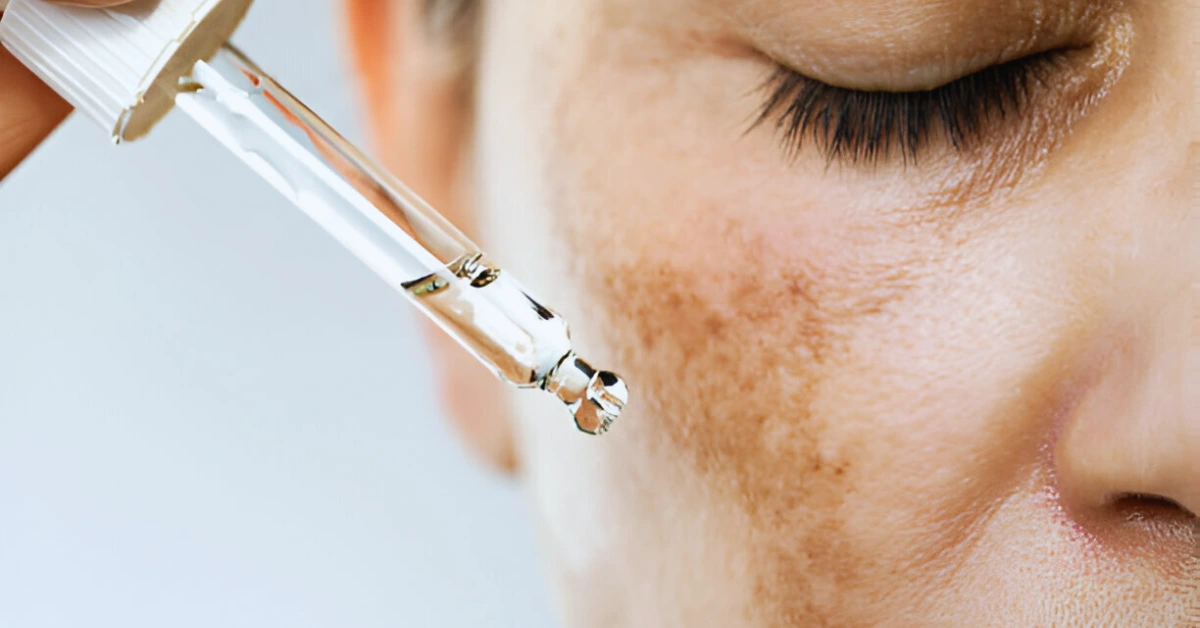 How To Cure Melasma From The Inside