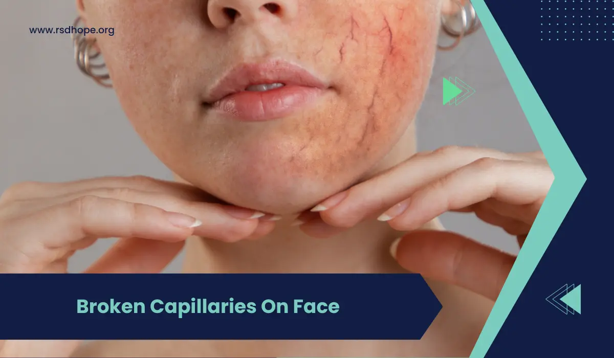 Broken Capillaries On Face