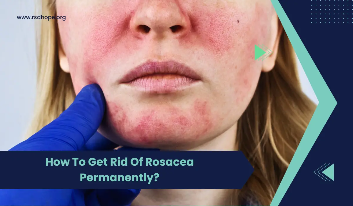 Get Rid Of Rosacea Permanently