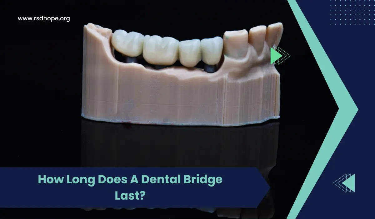 How Long Does A Dental Bridge Last
