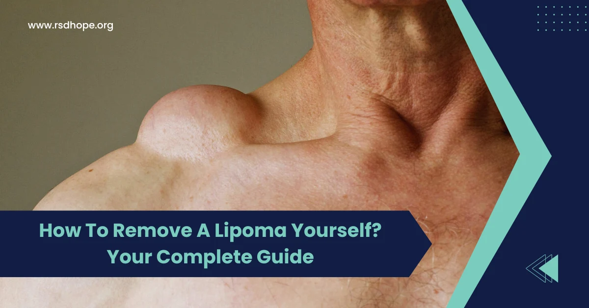 How To Remove A Lipoma Yourself