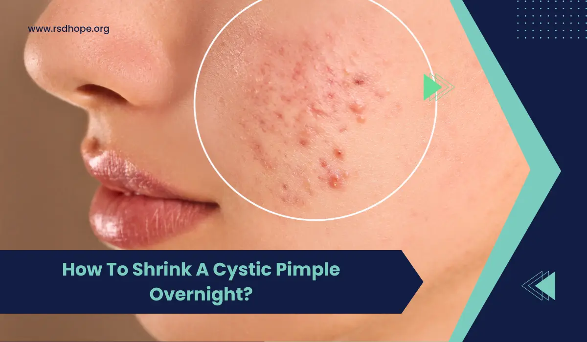How To Shrink A Cystic Pimple Overnight